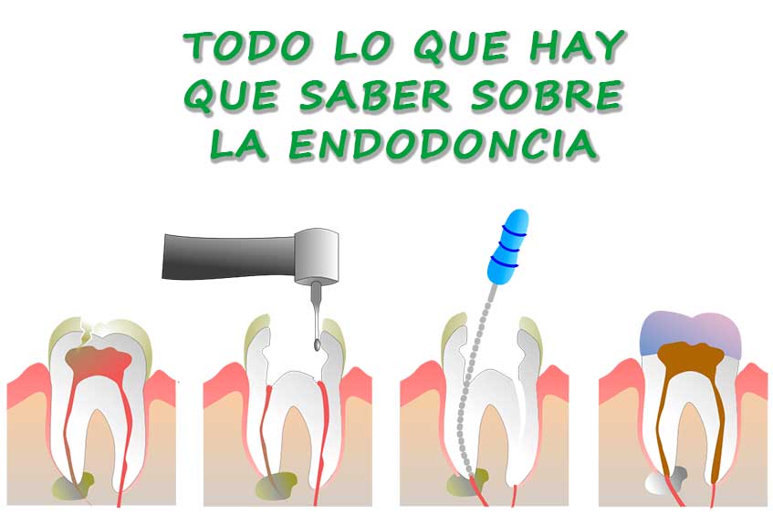 descubre-todo-sobre-la-endodoncia