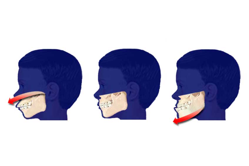 problemas-mandibula-mentoplastia-oviedo
