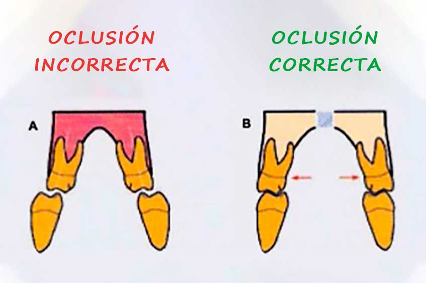 maloclusion-dental-correccion-oclusion-ortodoncia