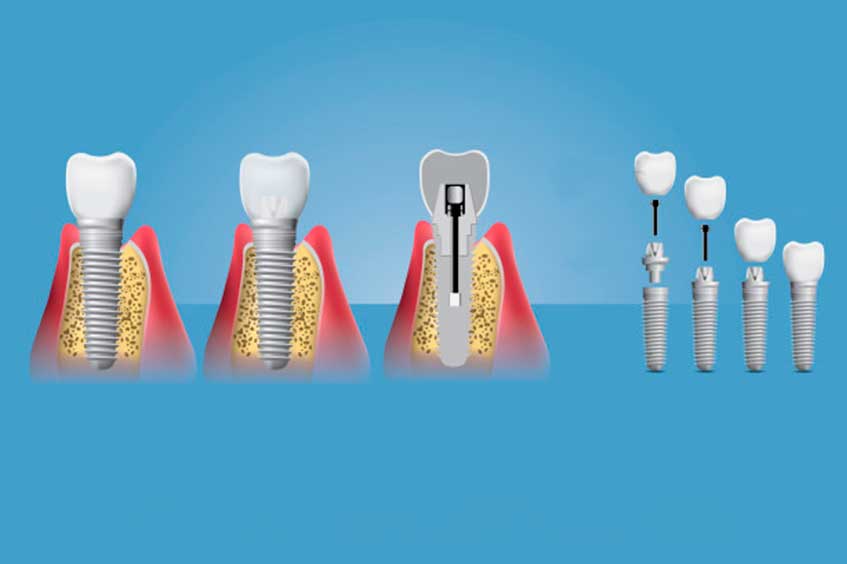 implantes-dentales-en-oviedo-dentista-especializado