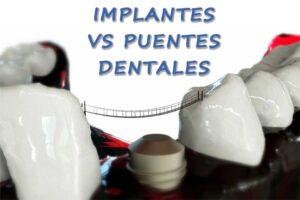 implantes-vs-puentes-dentales-oviedo-dentista