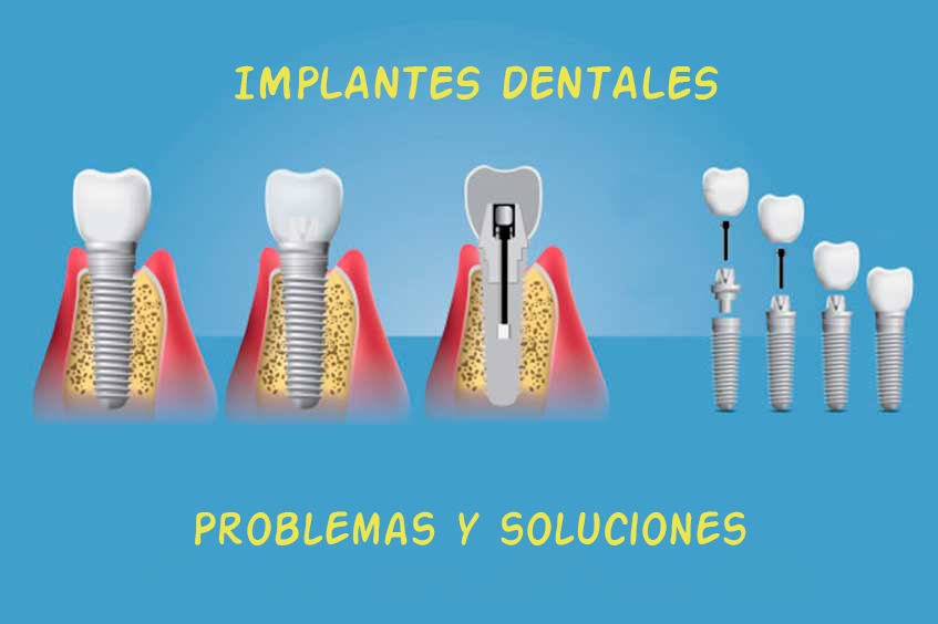 Implantes dentales: problemas y soluciones.