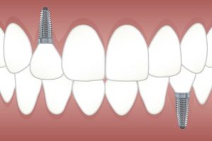 Dibujo de implantes dentales