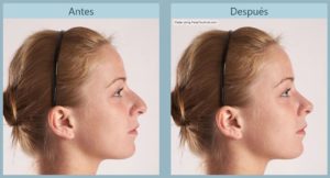 Antes y después de una rinoplastia