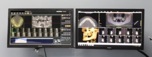Escaner 3D para implantes dentales
