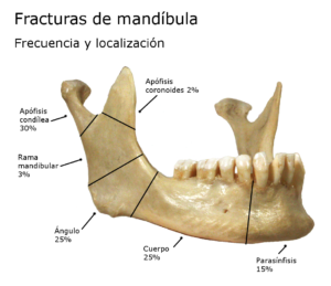 Fracturas de mandíbula