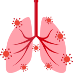 Pulmones con neumonía