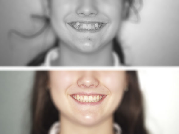 ortodoncia-niños-3